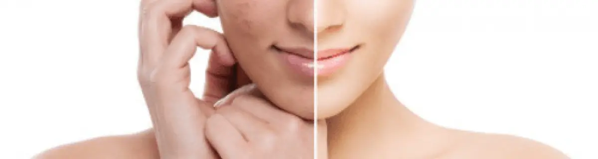 Peeling químico en Sant Cugat