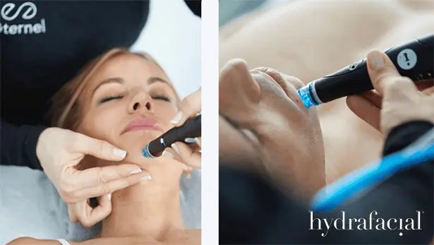 Tratamiento de Hydrafacial en Sant Cugat