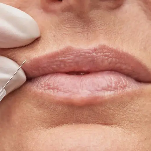 Ácido hialurónico en el código de barras de los labios