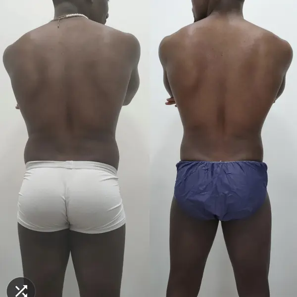 Antes y después de criolipólisis