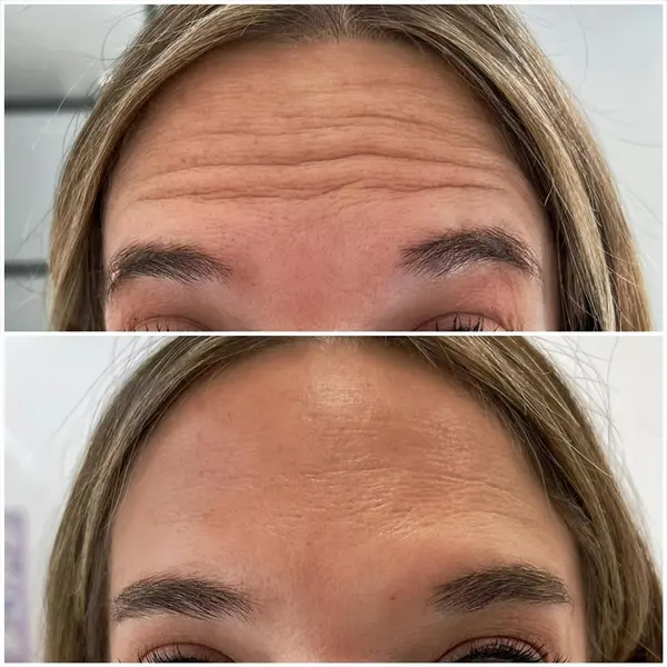 Antes y después de neuromodeladores
