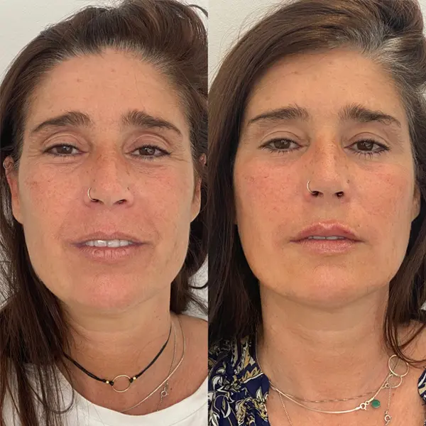 Antes y después de un rejuvenecimiento facial