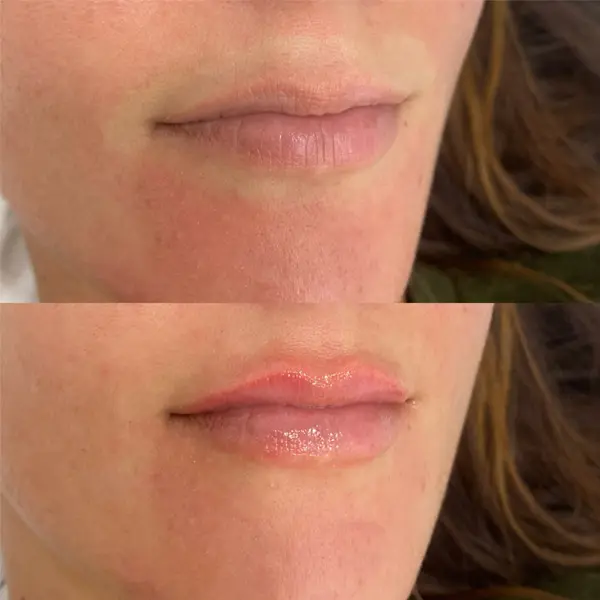 Antes y después del ácido hialurónico en los labios paciente 1