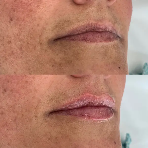 Antes y después del ácido hialurónico en los labios paciente 2