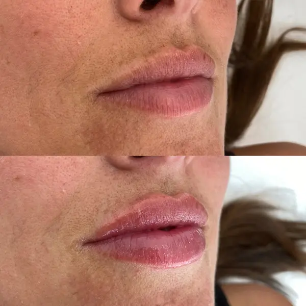 Antes y después del ácido hialurónico en los labios paciente 3