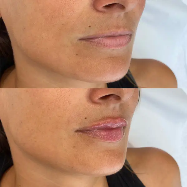 Antes y después del ácido hialurónico en los labios paciente 4