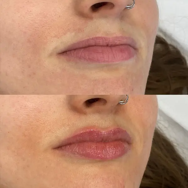 Antes y después del ácido hialurónico en los labios paciente 5