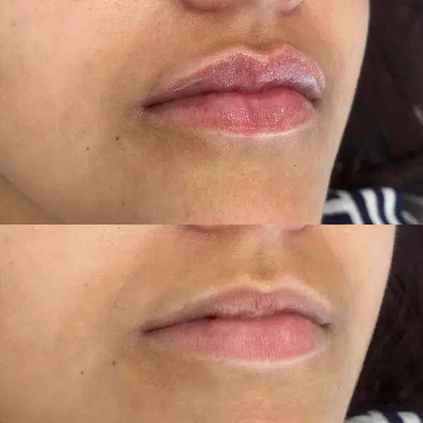 Antes y después del ácido hialurónico en los labios paciente 6