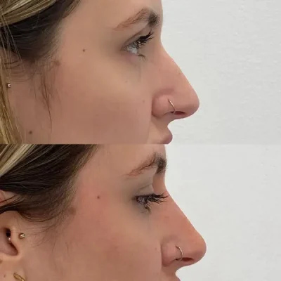 Antes y después de una rinomodelación sin cirugía en paciente 2