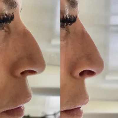Antes y después de una rinomodelación en paciente 1