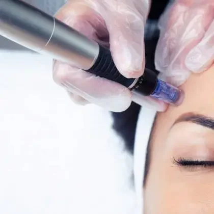Dermapen facial en Sant Cugat